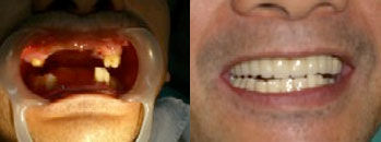 Ronaldo Lareta - Mini Dental Implants